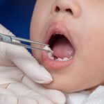 Chi Phí Nhổ Răng Sữa Tại Tân Mỹ Rin Dental Quận 12