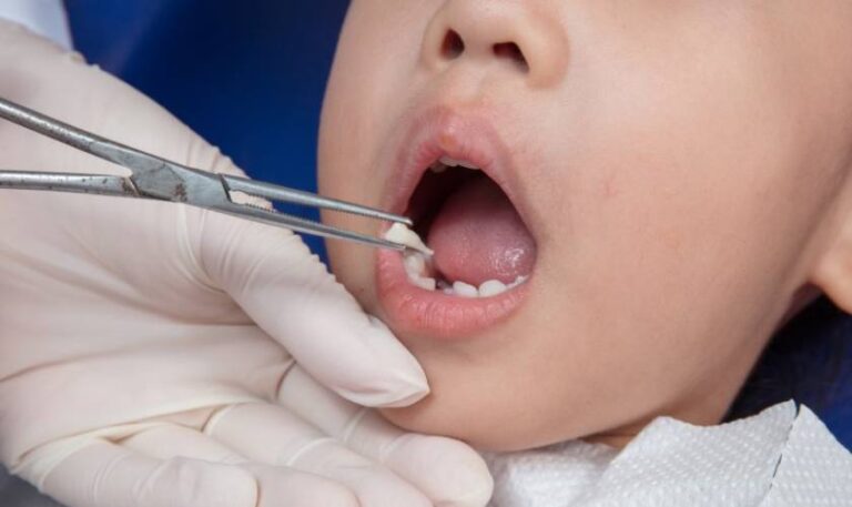 Chi Phí Nhổ Răng Sữa Tại Tân Mỹ Rin Dental Quận 12